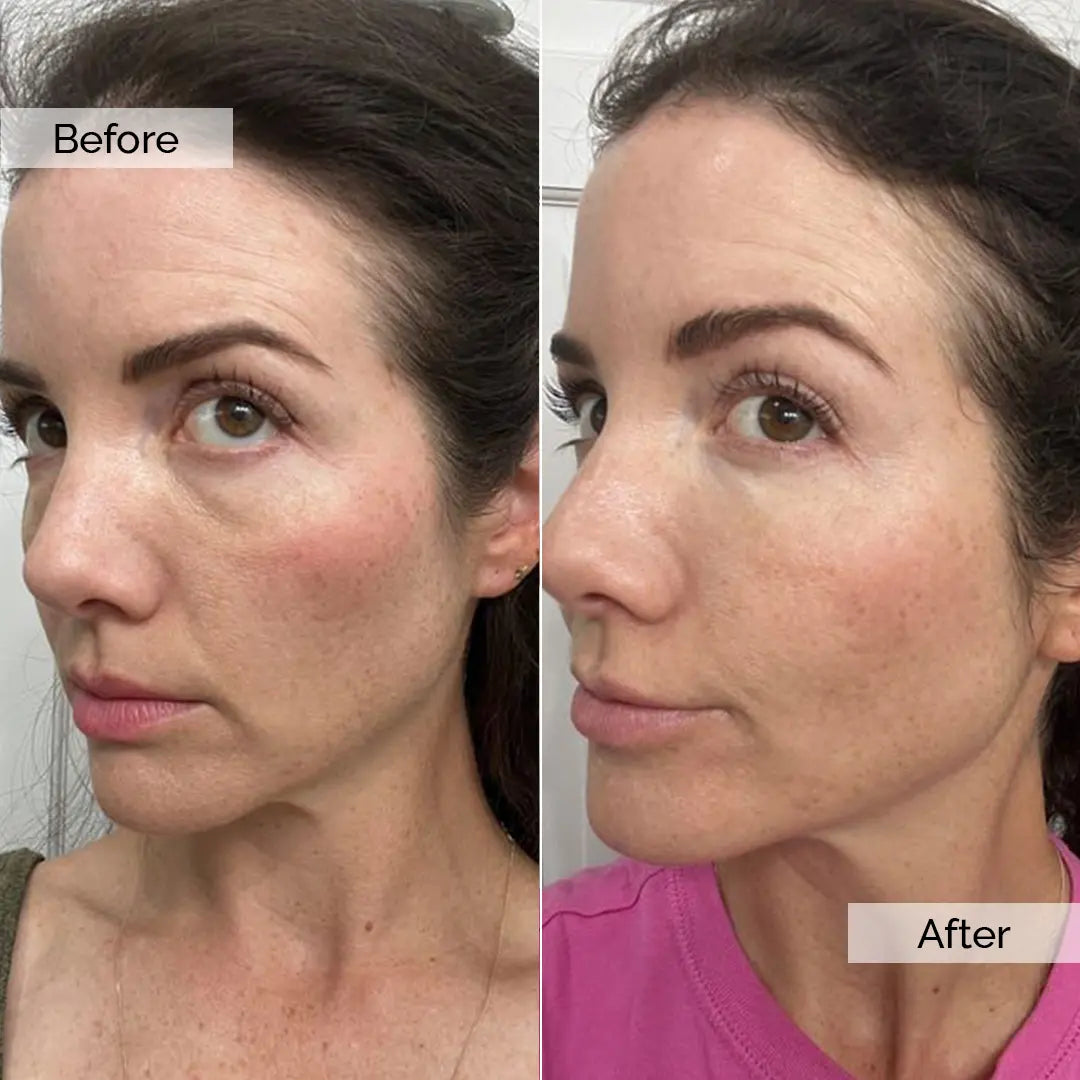 Before/After – Sarah