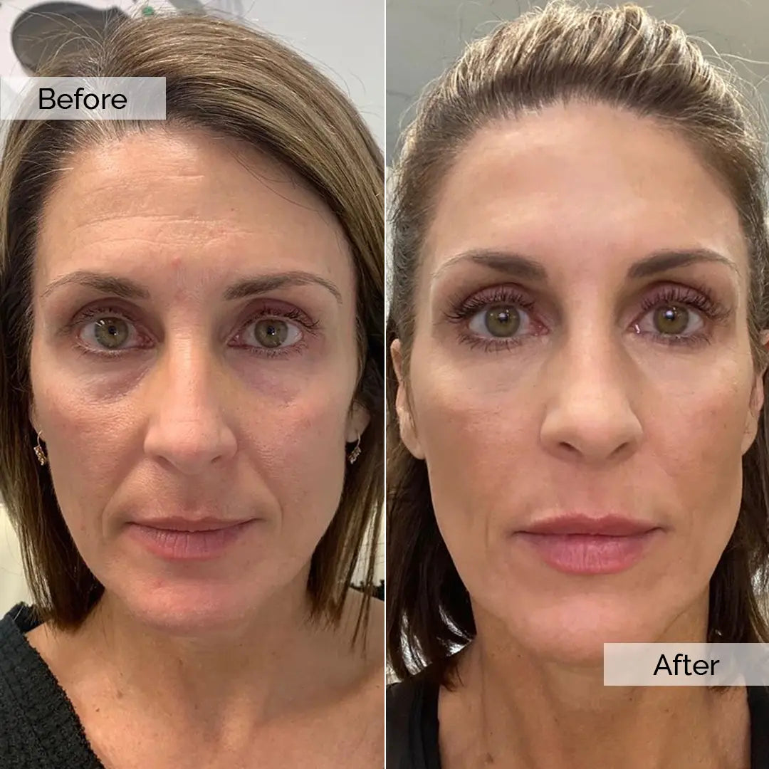 Before/After – Emma